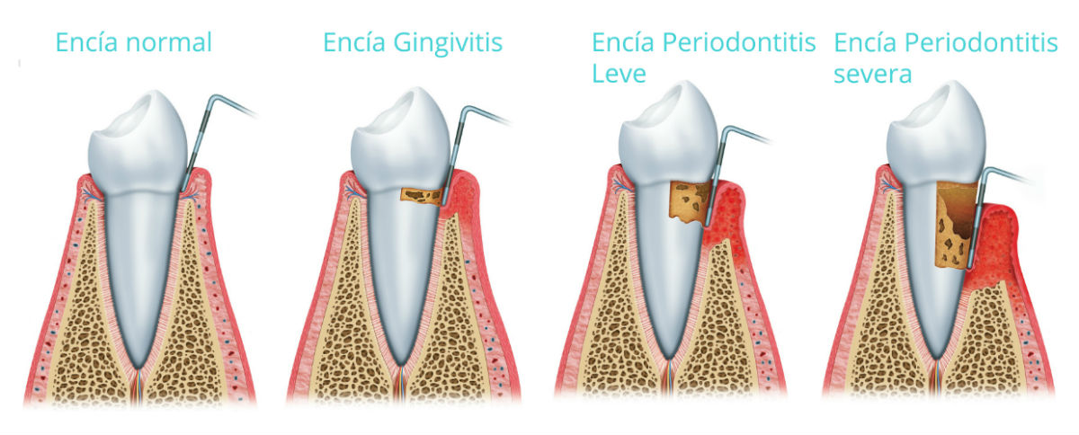 Cómo saber si tengo gingivitis y periodontitis? - Clínica Blasi